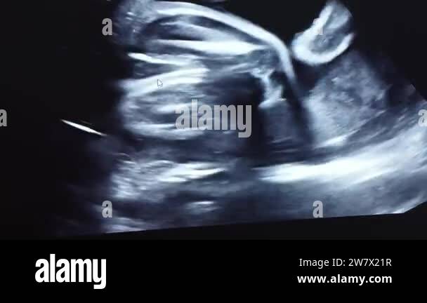 Ultrasound of pregnant woman to see her tiny baby in mother belly