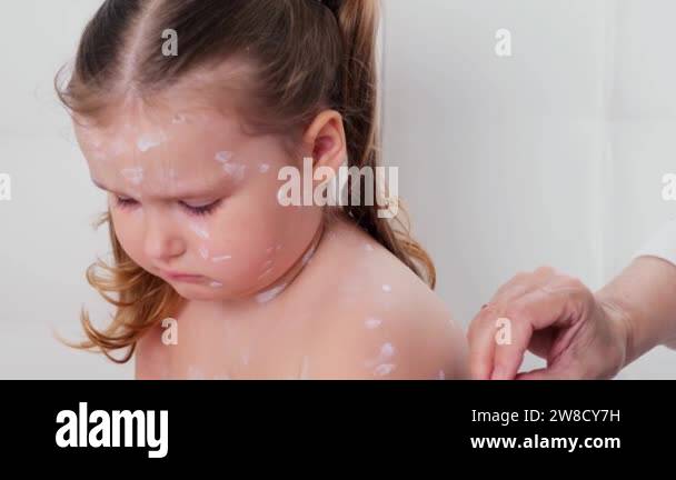 sad little girl with chickenpox, antiseptic cream applied to the rash ...