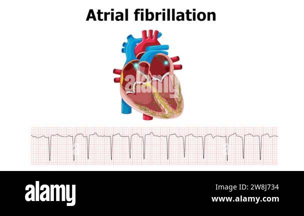 ecg shows atrial fibrillation arrhythmia with heart animation Stock ...