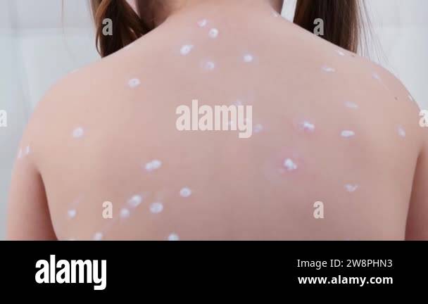 back girl with chickenpox, antiseptic cream applied to the rash. Rash ...