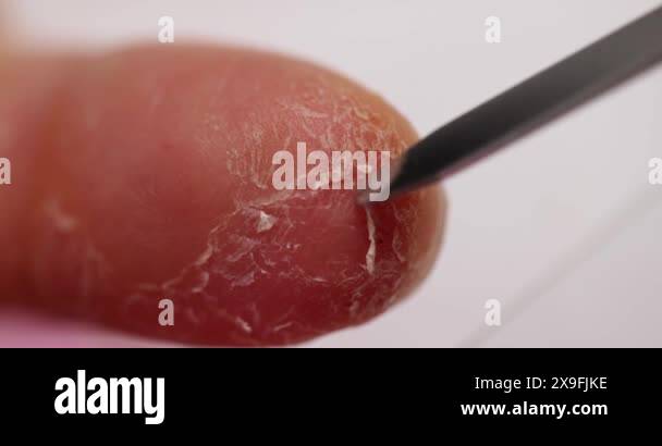 Dermatologist scrapes skin from a finger for analysis. Peeling skin on ...
