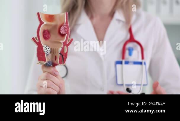 Rectum anatomy disease model Stock Videos & Footage - HD and 4K Video ...