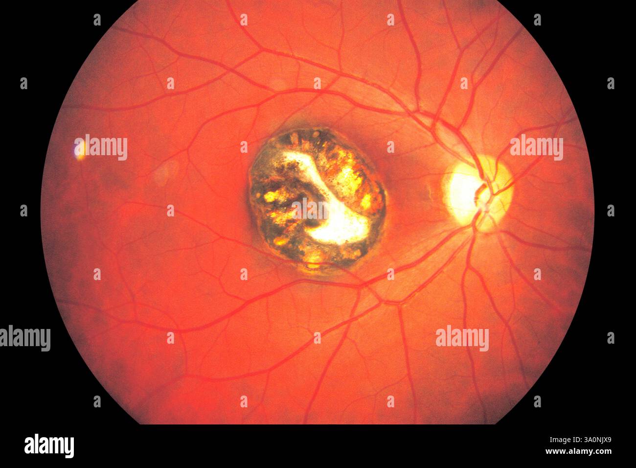 chorioretinitis-fundus-photograph-view-of-scarring-centre-on-the