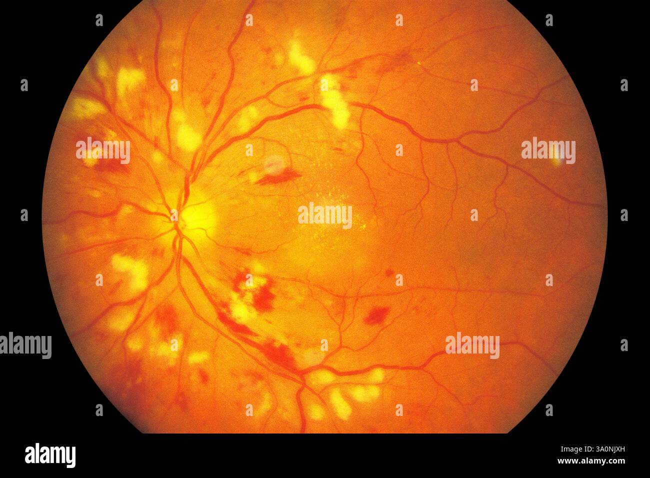 Hypertensive retinopathy, fundus photograph. View of the interior ...