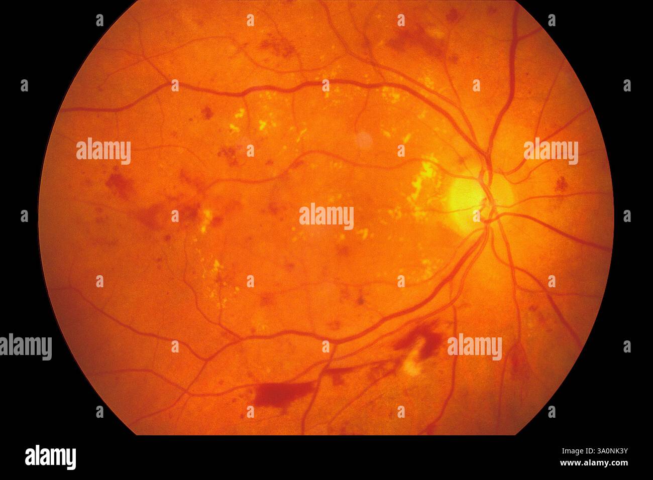 Diabetic retinopathy. Fundoscopy image of the retina of a patient's ...