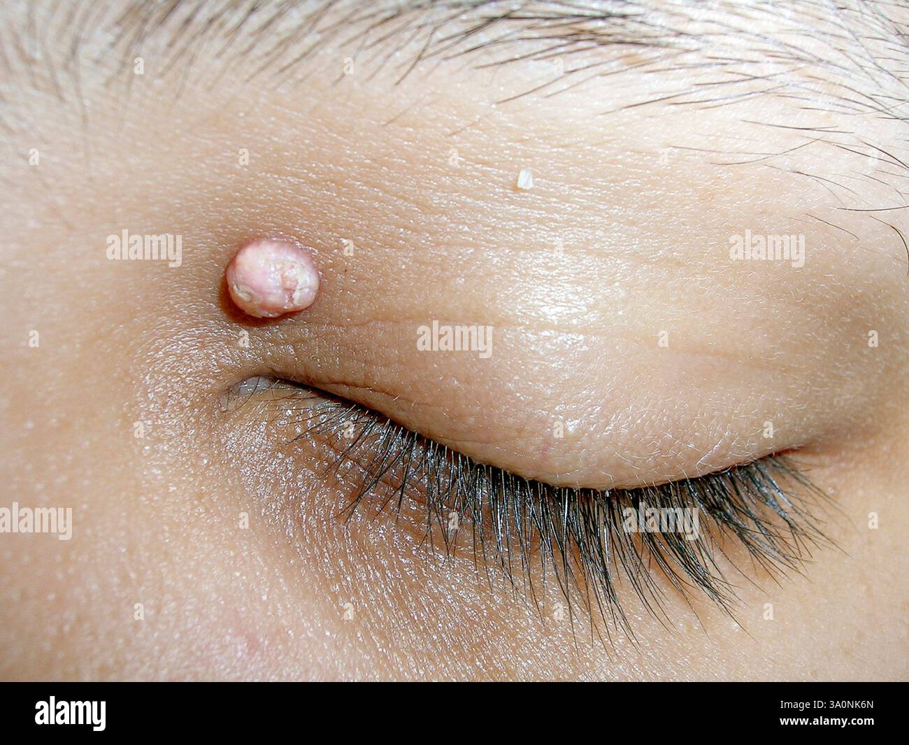 Benign (non-cancerous) growth on a patient's eyelid. For an image of this growth being treated with cryosurgery see C060/9085. Stock Photo