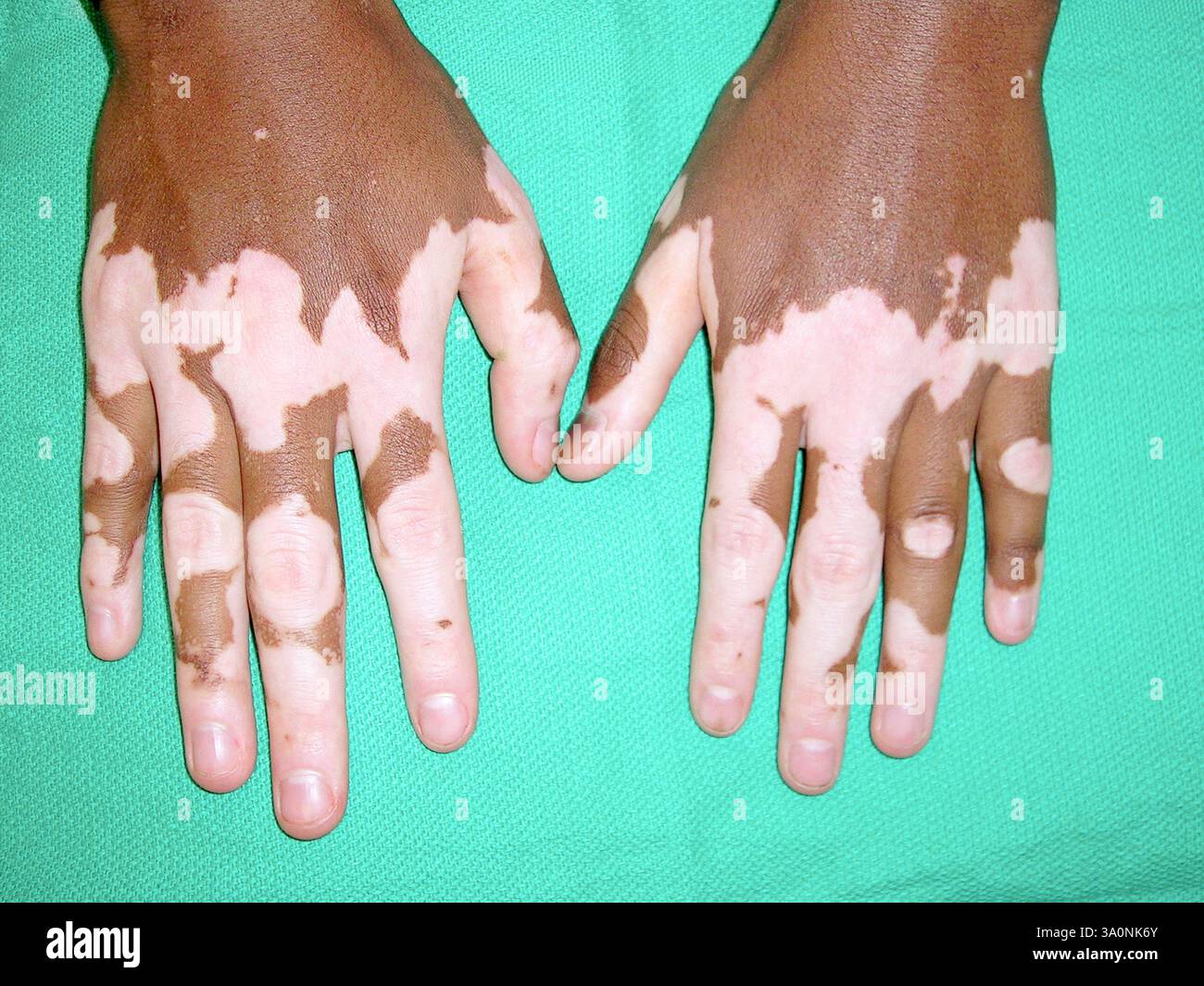 Vitiligo (loss of pigment) on the skin of the hands of a patient with ...