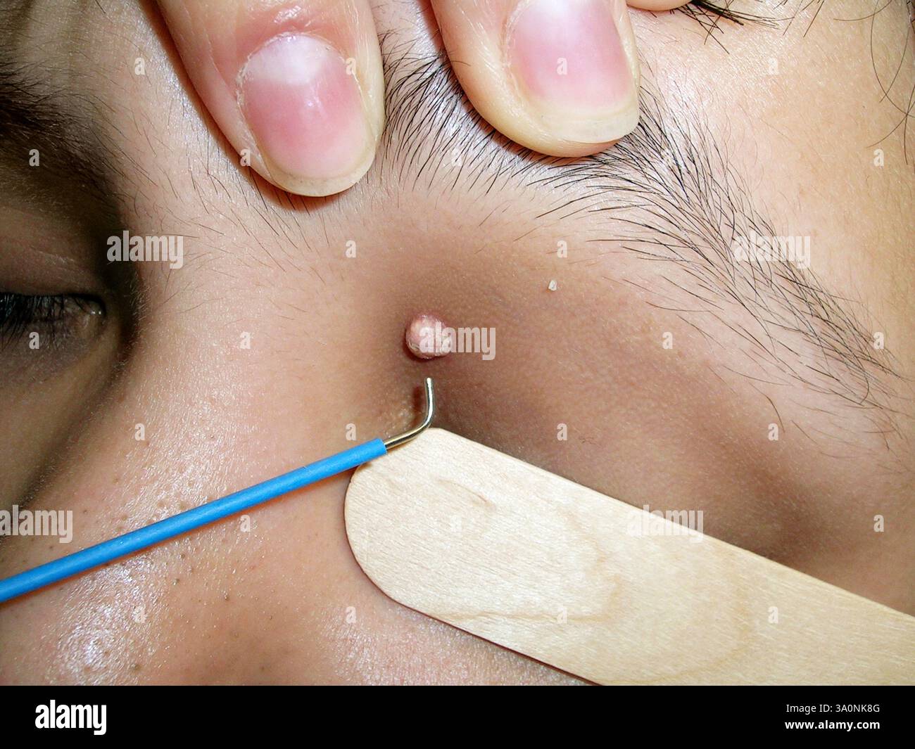 Benign (non-cancerous) growth on a patient's eyelid being treated with cryosurgery. Cryosurgery uses liquid nitrogen to kill and freeze the tissue. For this patient before treatment see C060/9086. Stock Photo