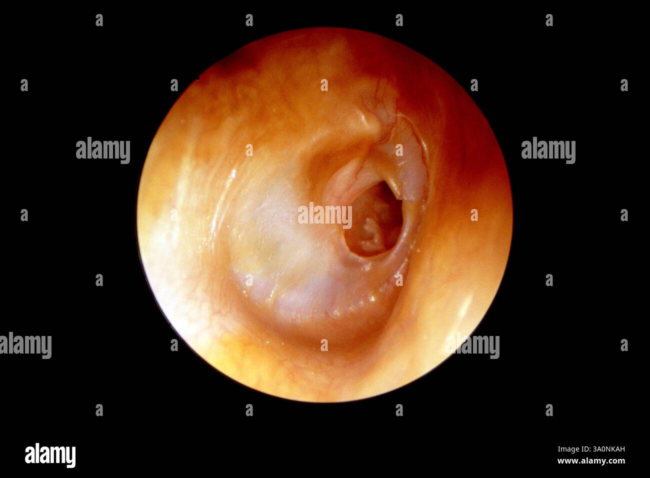 Perforated Ear Perforated eardrum. Otoscope view of a child's  perforated eardrum ...