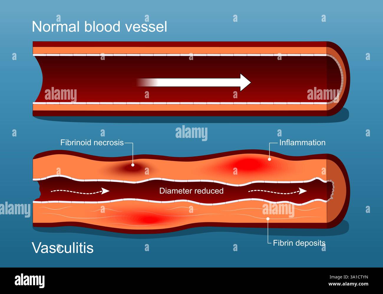 Vasculitis. Autoimmune disease. Healthy Blood vessel and Vascular damage with Diameter reduced, Inflammation, Fibrin deposits and Fibrinoid necrosis. Stock Vector