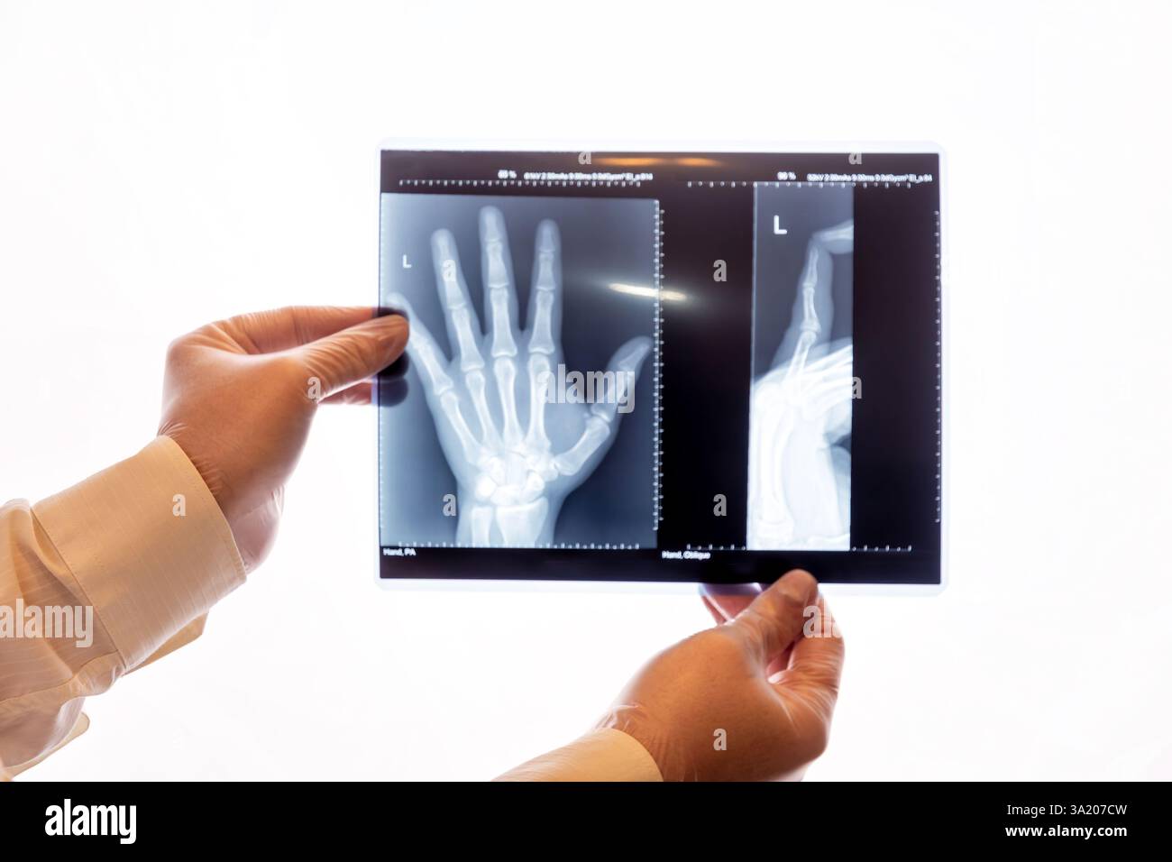 A doctor or radiologist is carefully reviewing a hand x-ray. Image ...