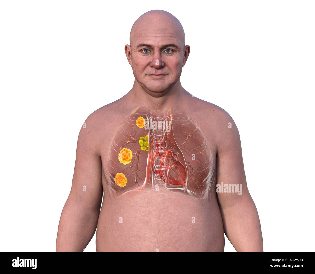 Illustration of human lungs affected by blastomycosis, a fungal ...