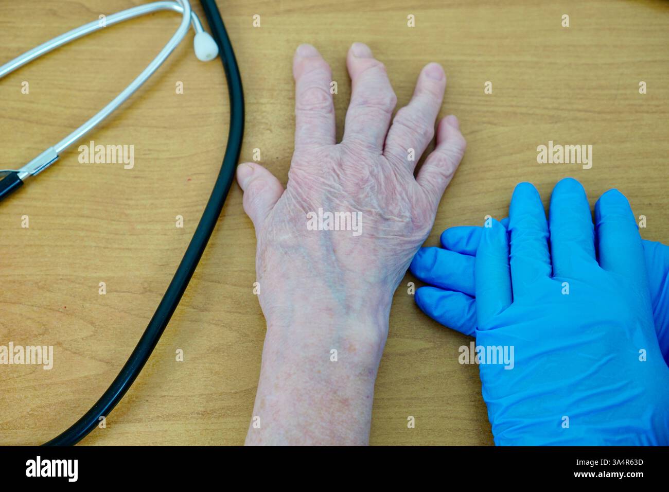 Arthritic Womens Hand with Bone Deformity. High quality photo Stock Photo