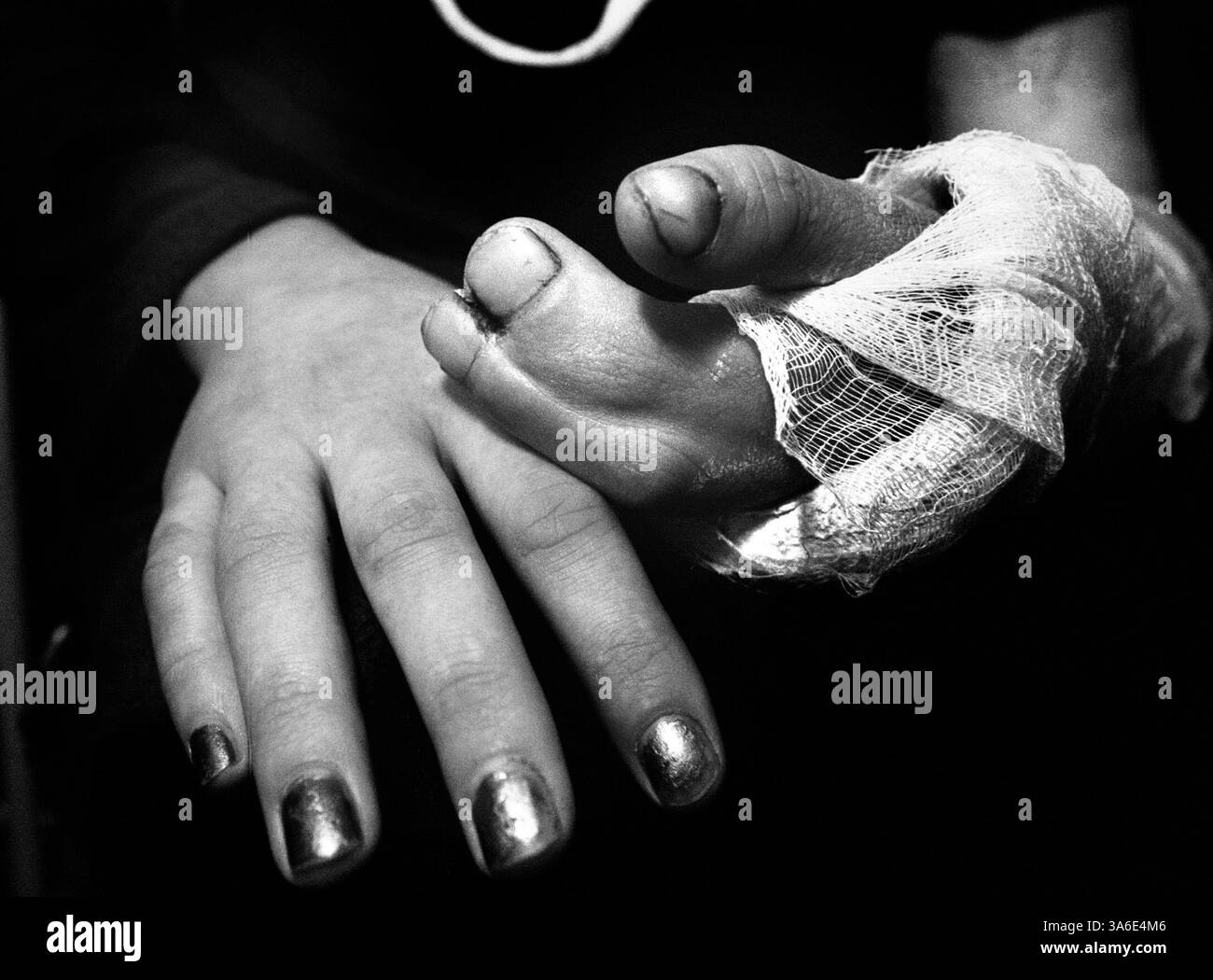 Fused fingers hi-res stock photography and images - Alamy