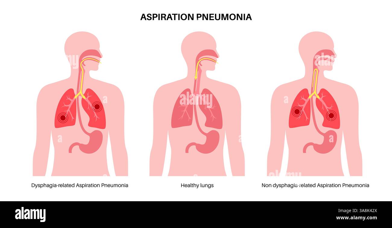 Aspiration Pneumonia Illustration Aspiration Pneumonia Is A Lung aspiration-pneumonia-illustration-aspiration-pneumonia-is-a-lung
