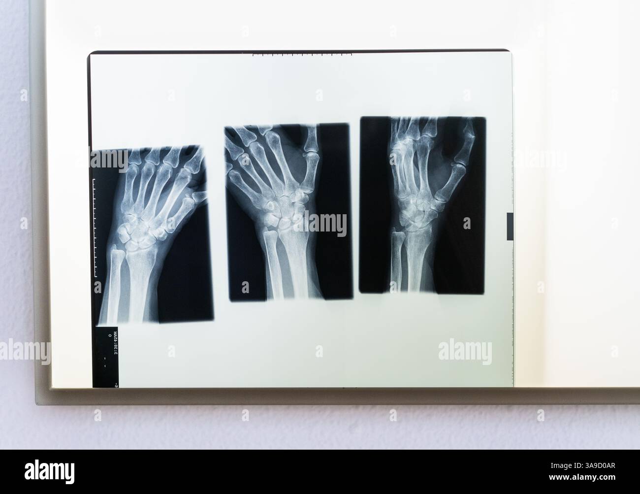 With a radiograph of the hand hi-res stock photography and images - Alamy