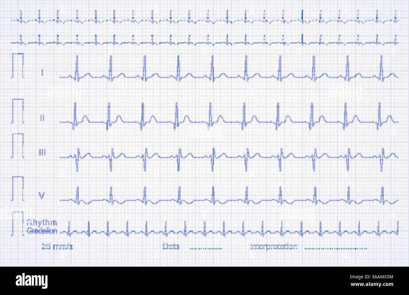 ECG pattern on the linear graph paper, vector illustration. Stock Vector