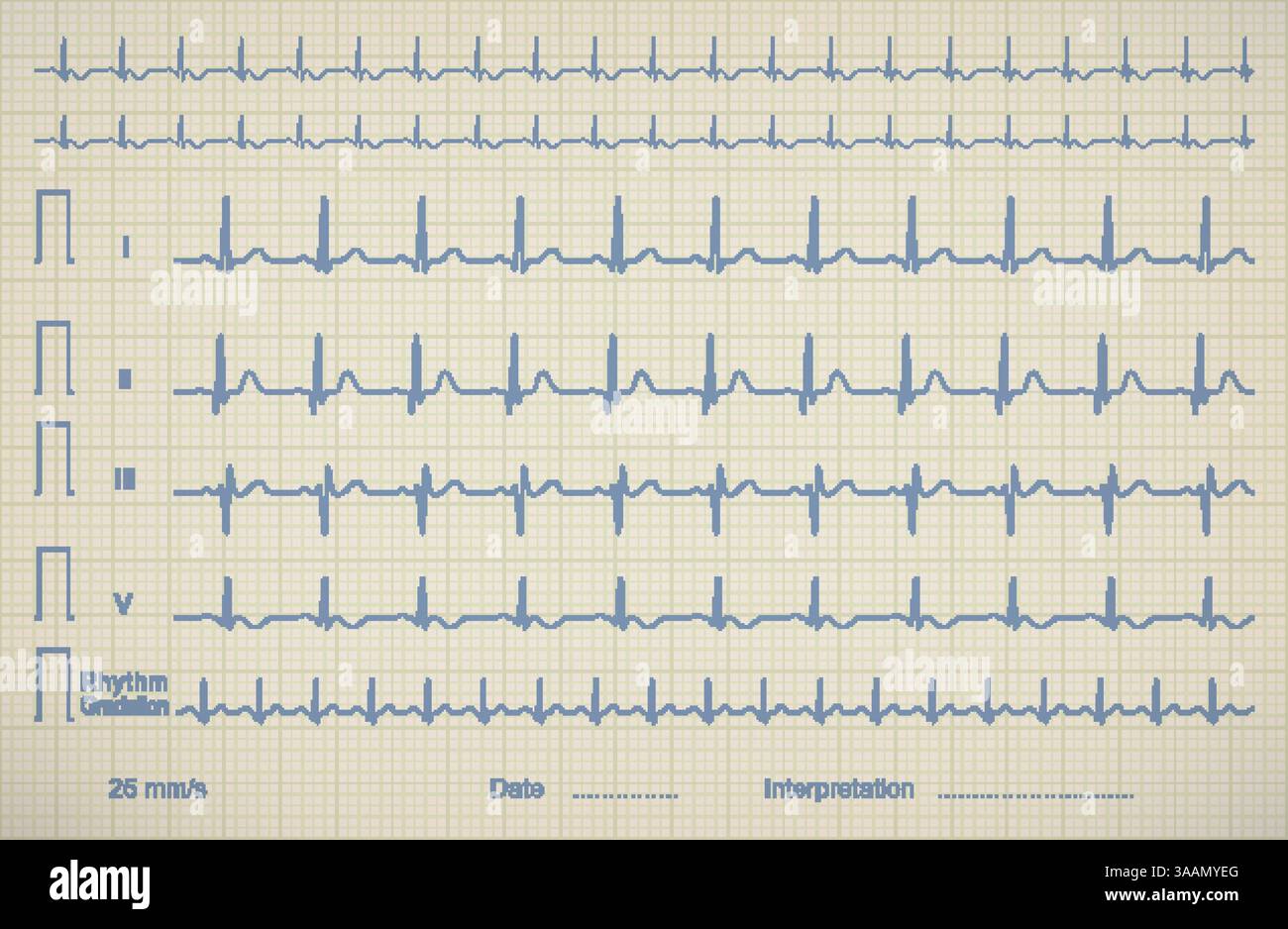 ECG chart image of medical patient, vector illustration Stock Vector