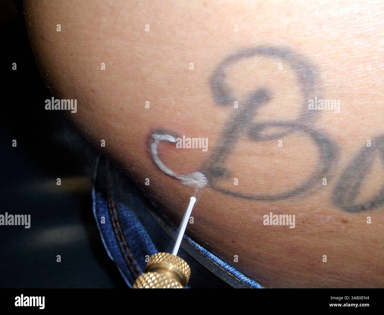 Cryotherapy to remove a tattoo. For this tattoo before cryotherapy see C061/1505. Stock Photo