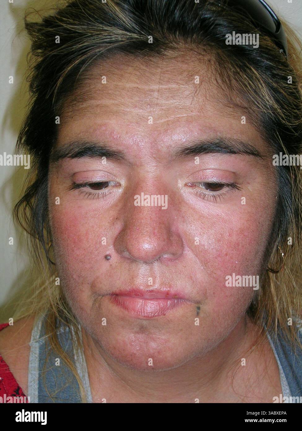 Rash on the face of a patient with dermatomyositis. Dermatomyositis is ...