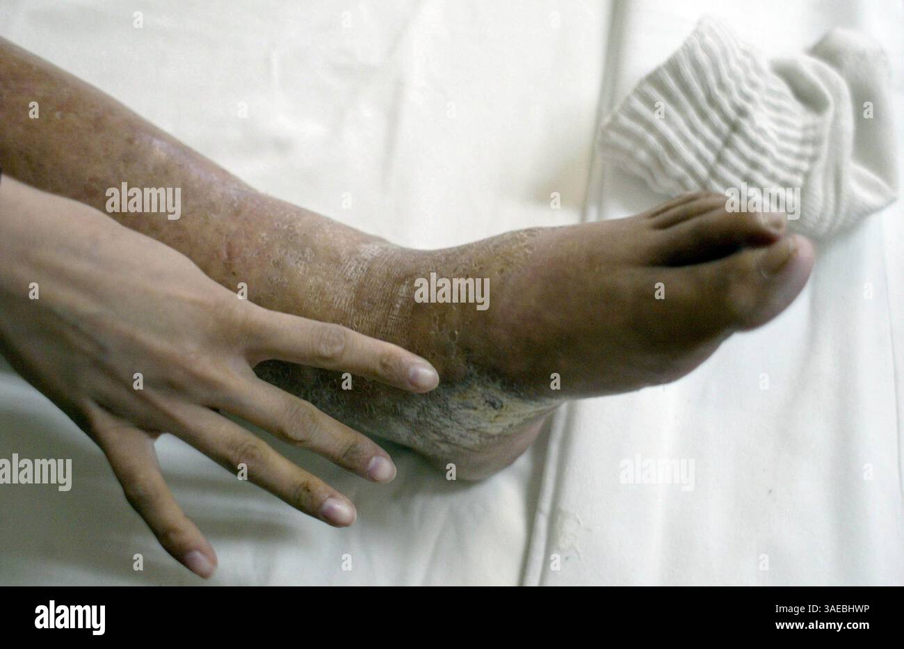 Nov 04, 2004; Mexico City, DF, Mexico; SILVIA'S slender 27 year old hand points out the dry, hard skin and sores on her innflamed legs and feet on her hospital bed in Mexico City's General Hospital. Silvia is only half way through an 8 month stay at the hospital due to ulcers, inflamations, and infections 10 years after getting injections at an underground clinic..  (Credit Image: Sarah Meghan Lee/ZUMAPRESS.com) Stock Photo