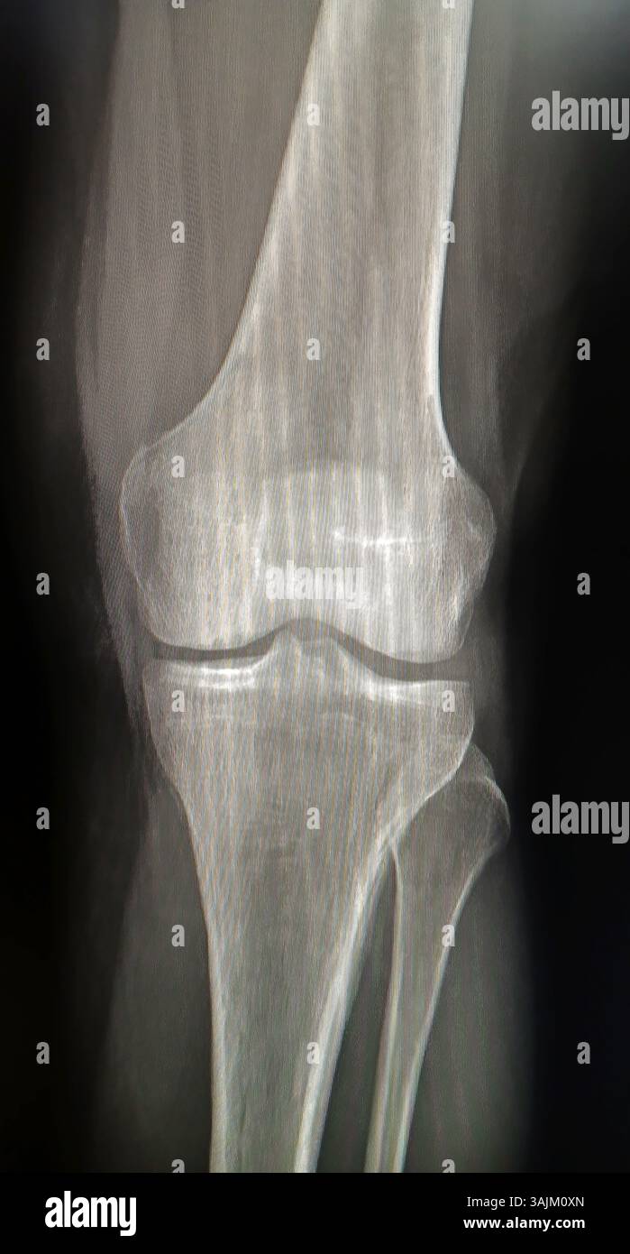 X-ray image depicting detailed view of a human knee joint Stock Photo ...