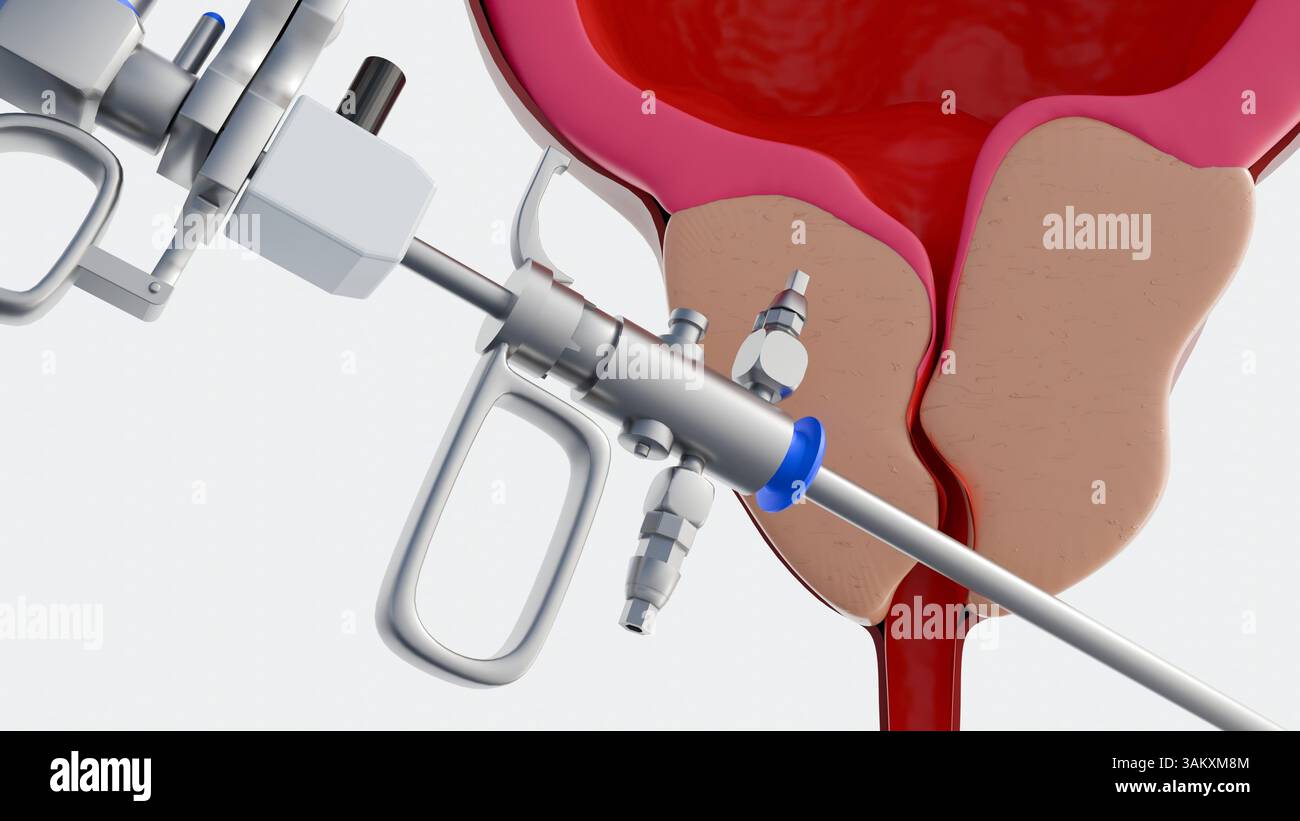 A 3d rendering of resectoscope and benign prostatic hyperplasia or BPH ...