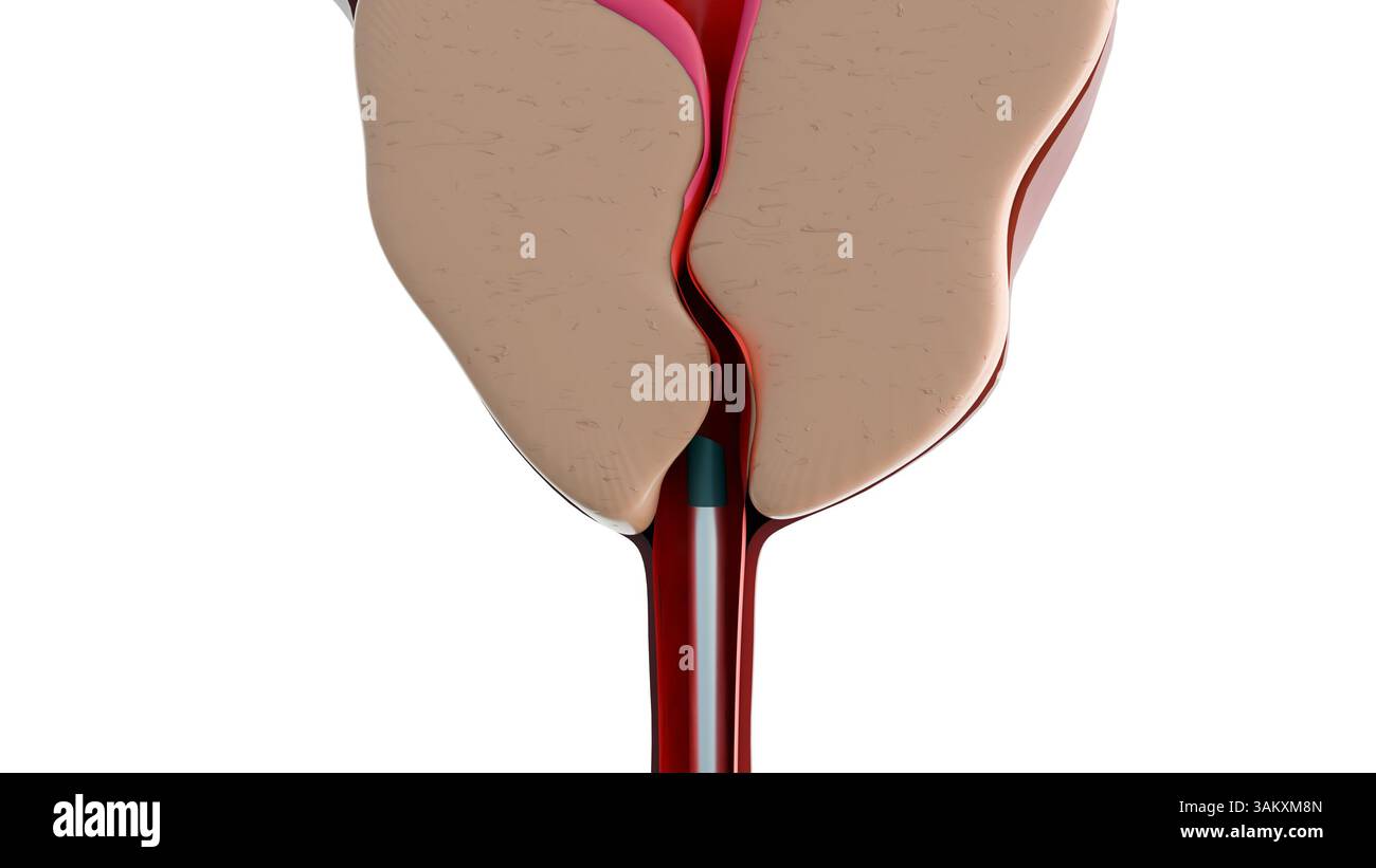A 3d rendering of resectoscope and benign prostatic hyperplasia or BPH ...