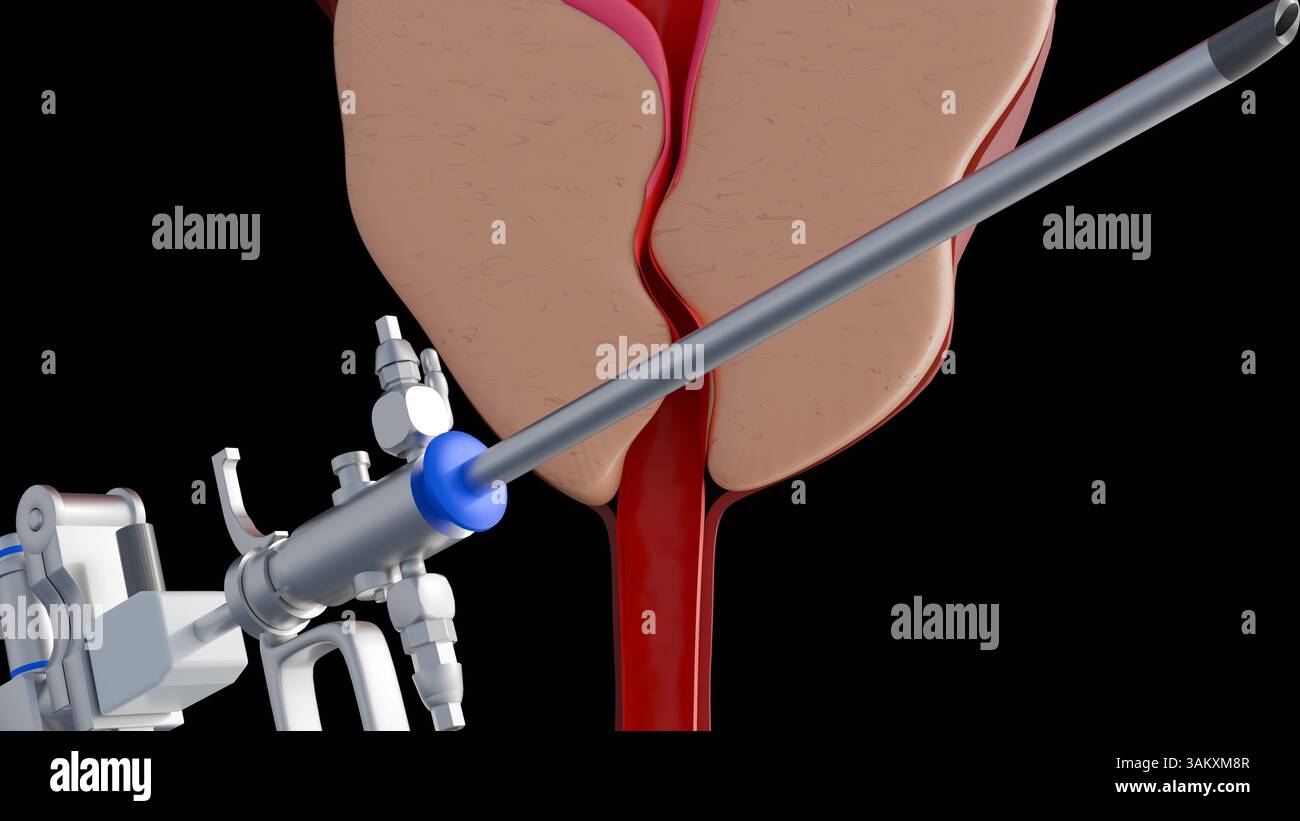 A 3d rendering of resectoscope and benign prostatic hyperplasia or BPH ...