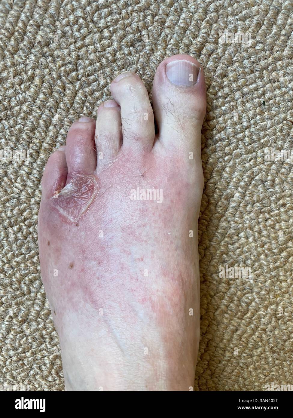 Burst skin blister on foot near toes on adult Caucasian male - Smartphone Captured Stock Image