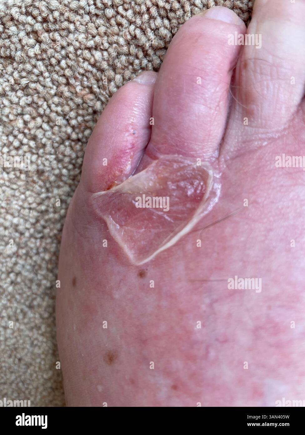 Burst skin blister on foot near toes on adult Caucasian male - Smartphone Captured Stock Image