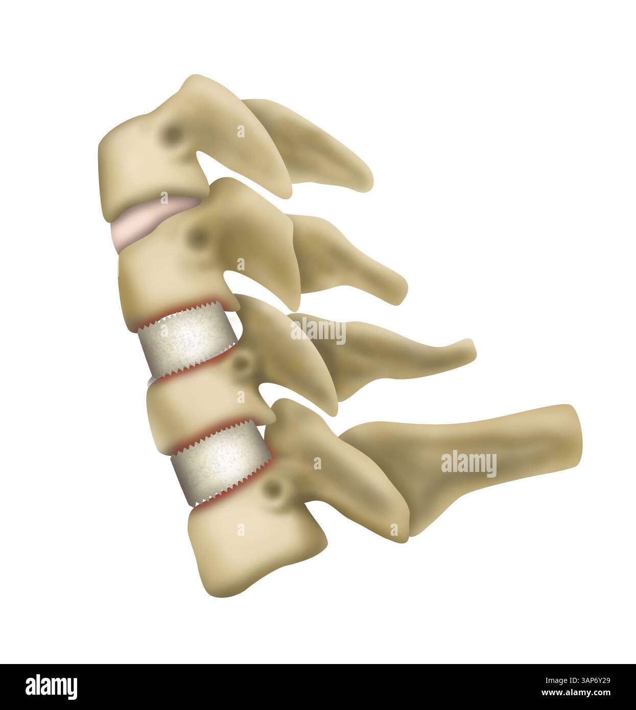 Illustration of damaged cervical (neck) vertebrae and discs Stock Photo ...