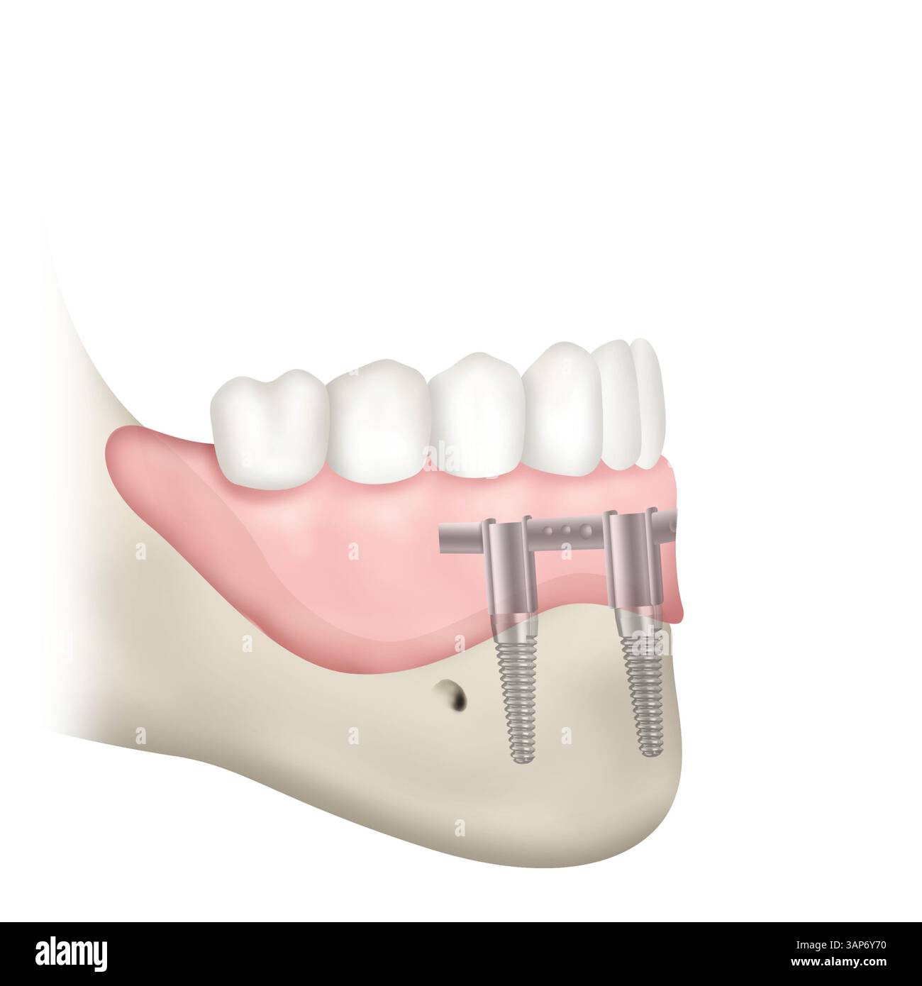 Illustration of a resorbed mandible (lower jaw) with an angled bar ...