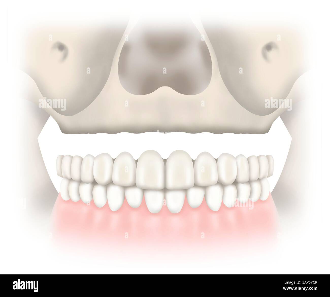 Resorbed maxilla (upper jaw) with composite defect, illustration. A ...