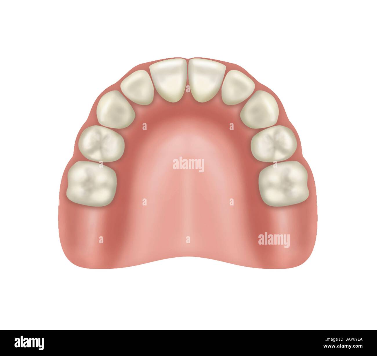 Illustration of a mildly resorbed edentulous maxillary (upper jaw) arch ...