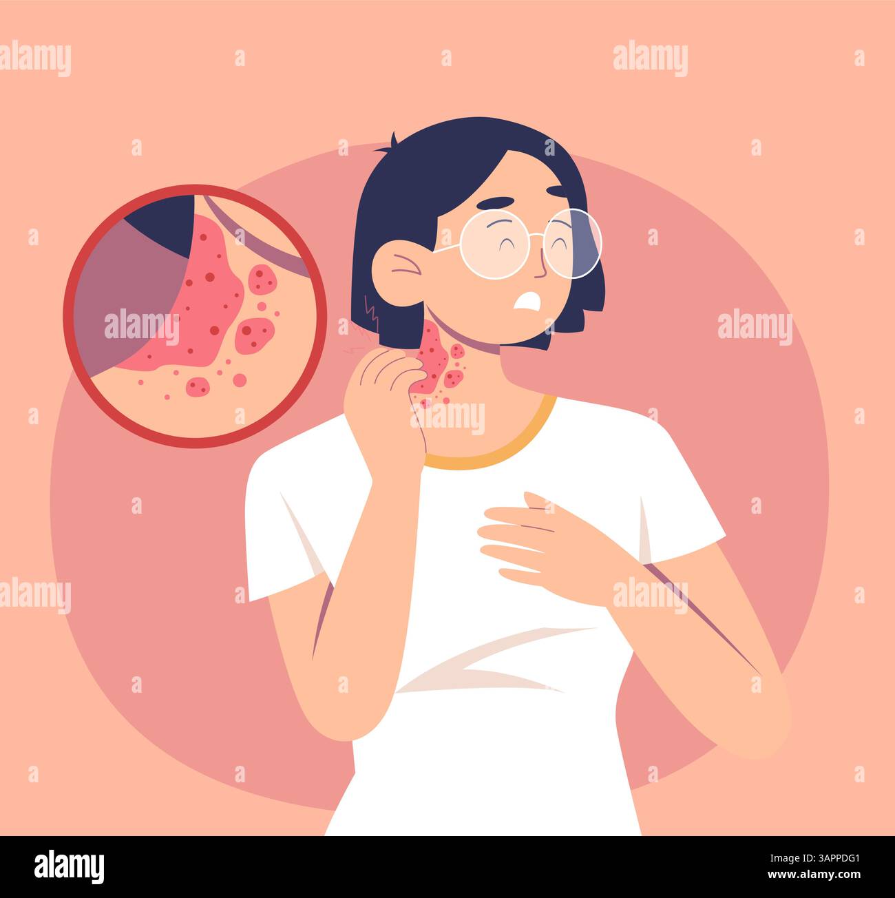 Painful Skin Rashes and Spots on Neck - Stock Illustration as EPS 10 ...