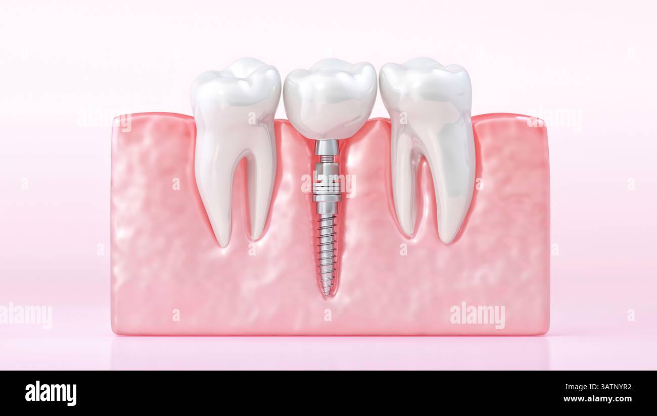 Tooth Imploding Illustration of a tooth implant procedure. A titanium implant is placed ...