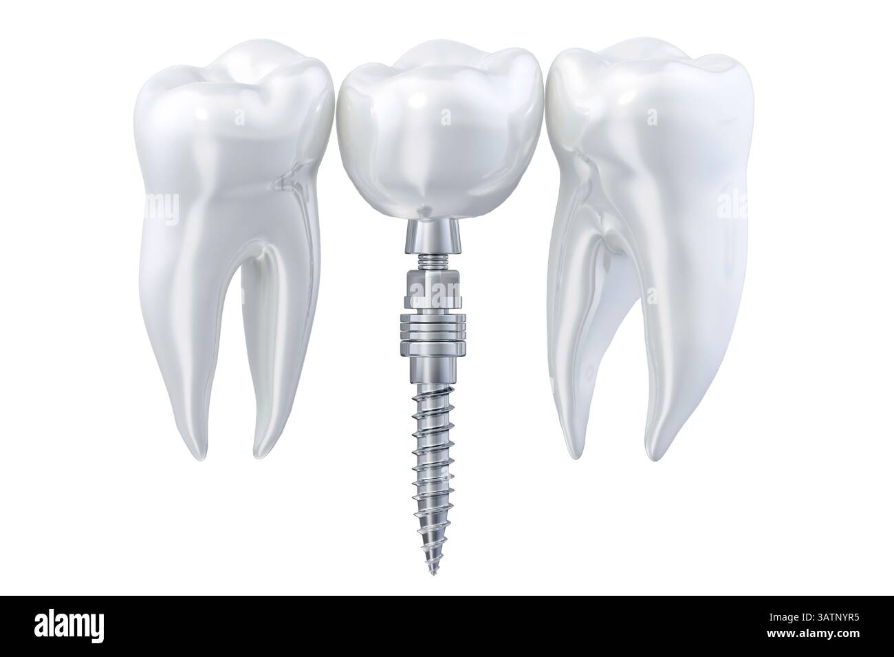 Tooth Imploding Illustration of a tooth implant procedure. A titanium implant is placed ...