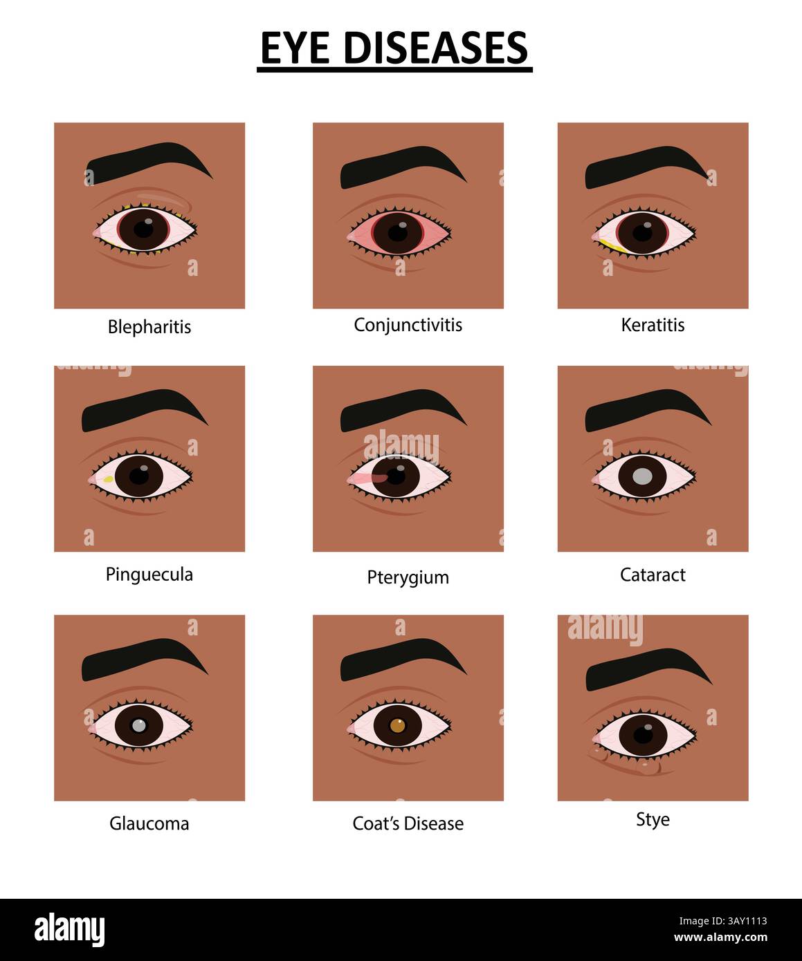 Exquisite Eye Disease Symptoms Moment for Desktop Exquisite Eye Disease Symptoms Moment for Desktop