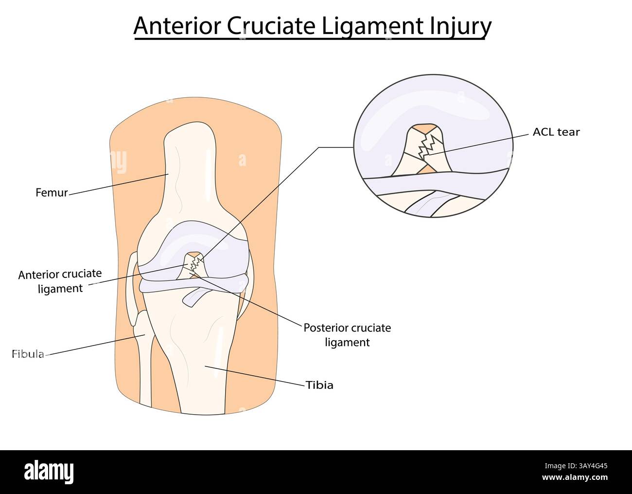 Cruciate ligament diagram hi-res stock photography and images - Alamy