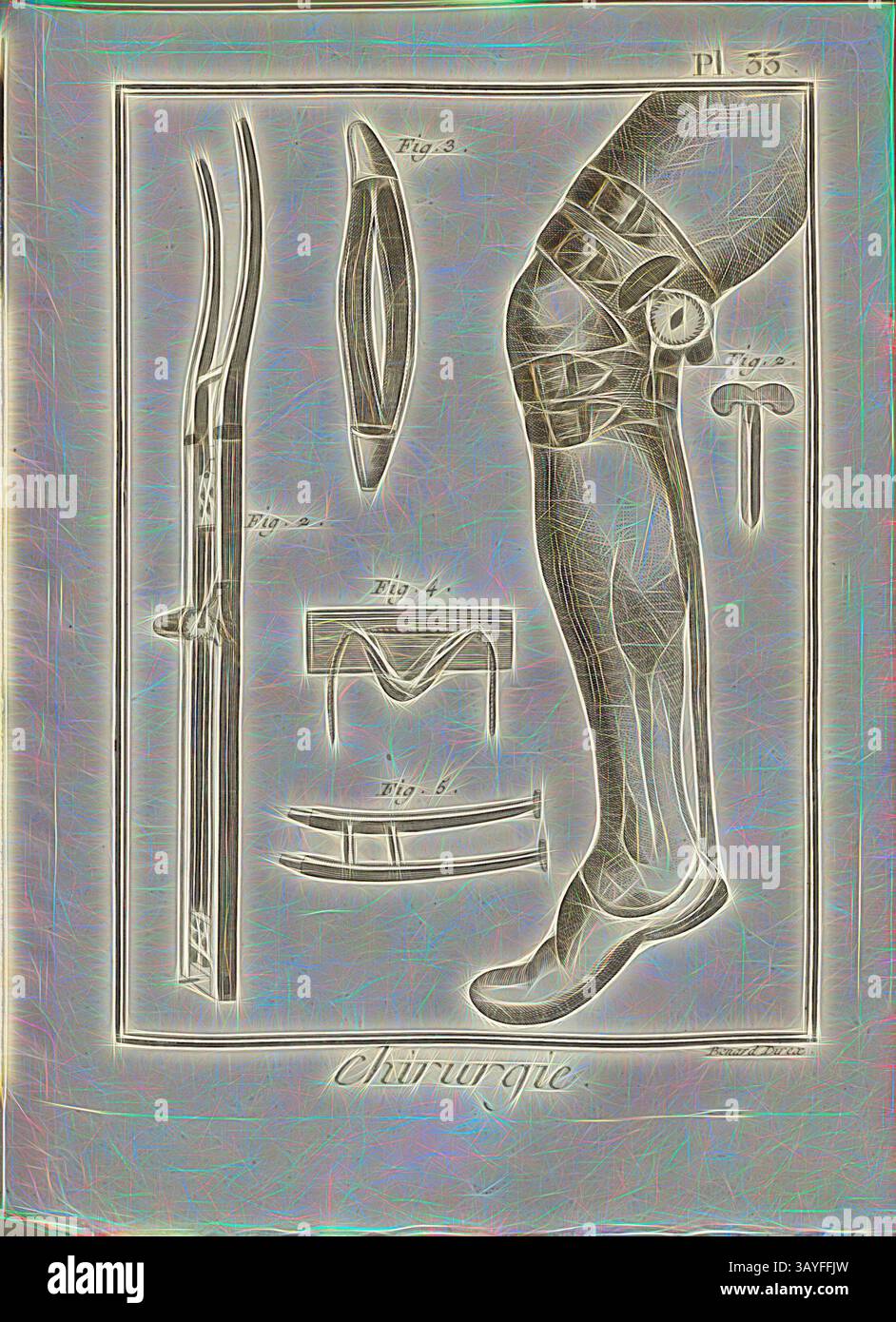 Aufranc Gouges An illustration featuring various surgical instruments and a leg ...