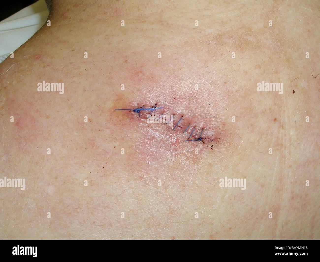 Stitched wound on a patient's shoulder after the removal of an epidermoid cyst. Epidermoid cysts develop from ectodermal tissue and consist of a thin layer of squamous epithelium. Stock Photo