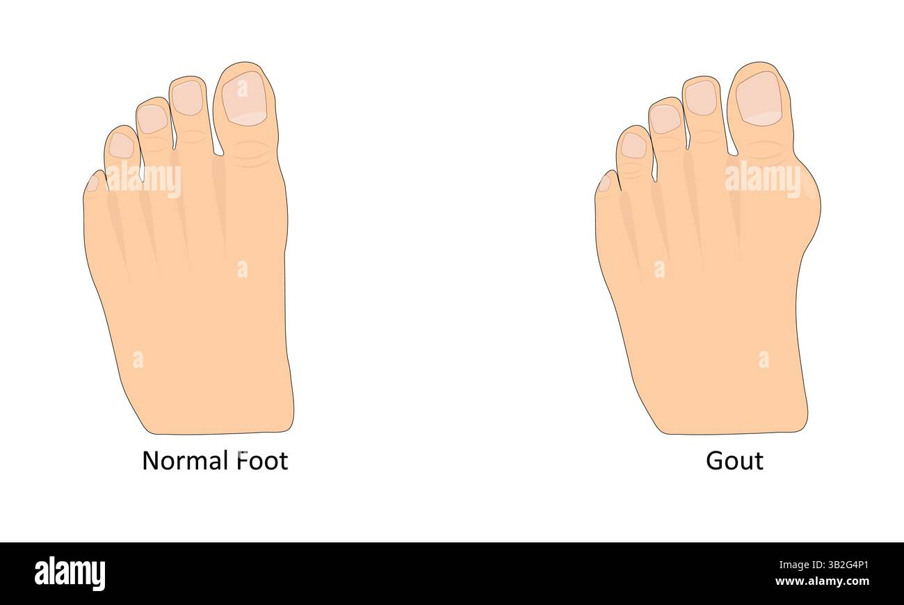 Gout foot disease vector illustration Stock Vector Image & Art - Alamy