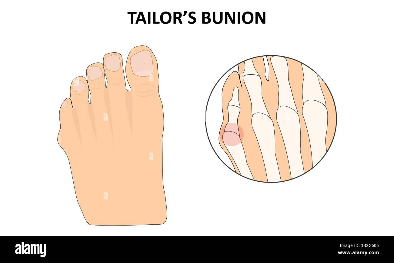Pinky toe hi-res stock photography and images - Alamy