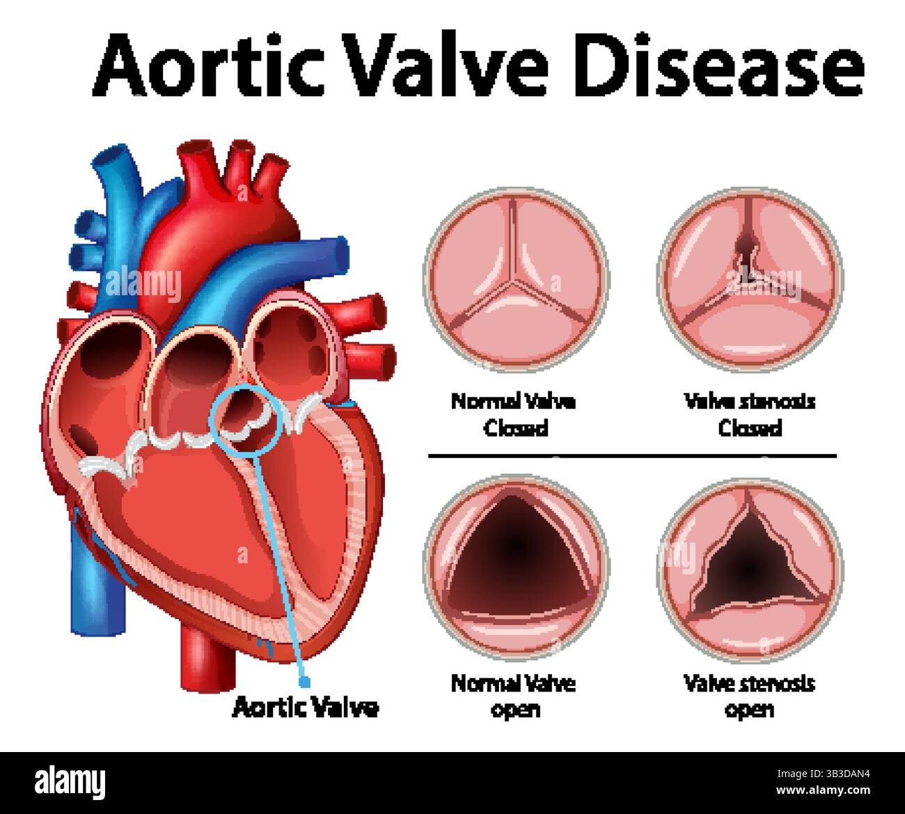 Detailed Vector Illustration Of Aortic Valve Disease Highlighting Detailed Vector Illustration Of Aortic Valve Disease Highlighting