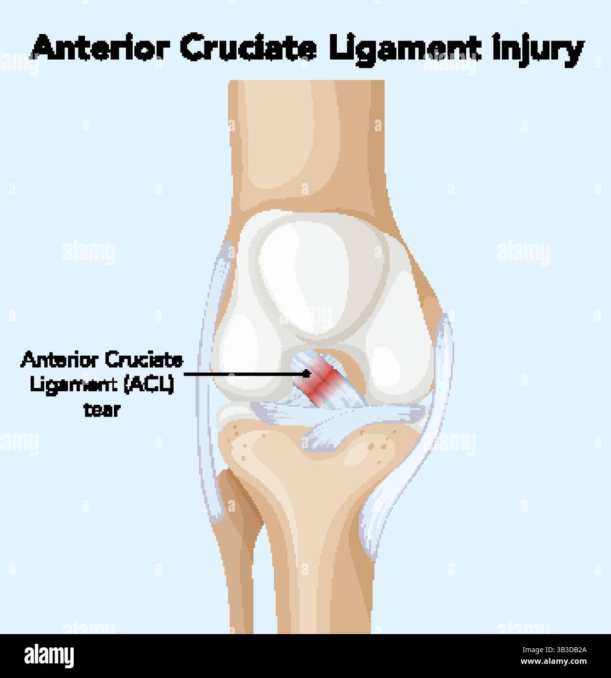 Vector illustration showing an ACL tear in the knee joint. Clear ...