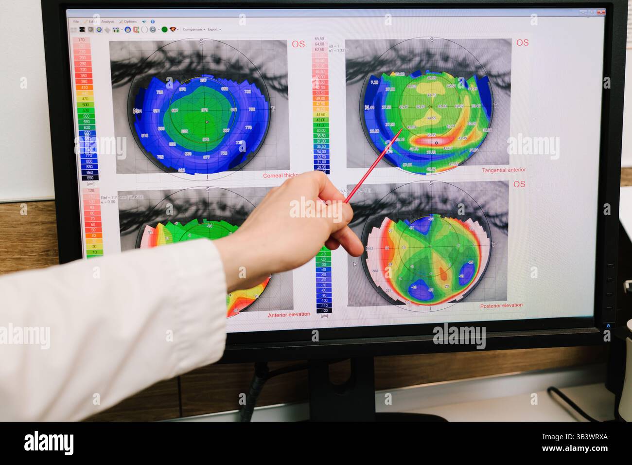 Diagnosis of the cornea and eyes in ophthalmology clinic ...