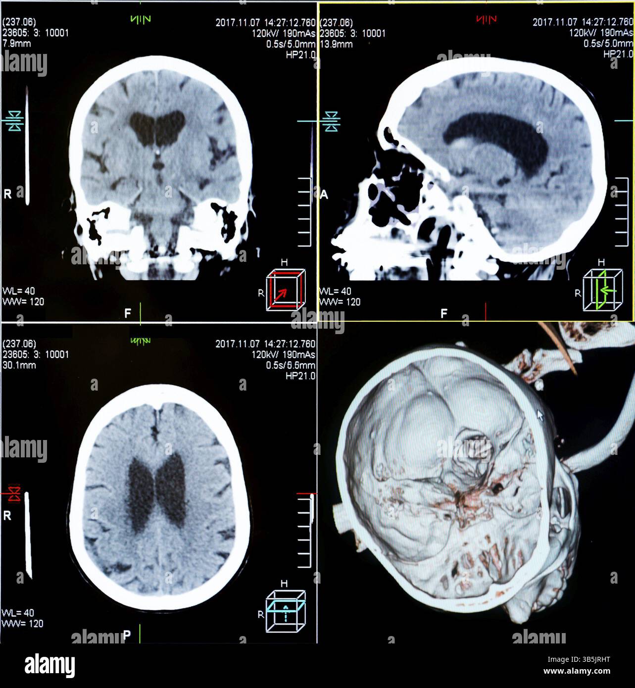 Magnetic resonance imaging (MRI) scan - CT scans of human head on a ...