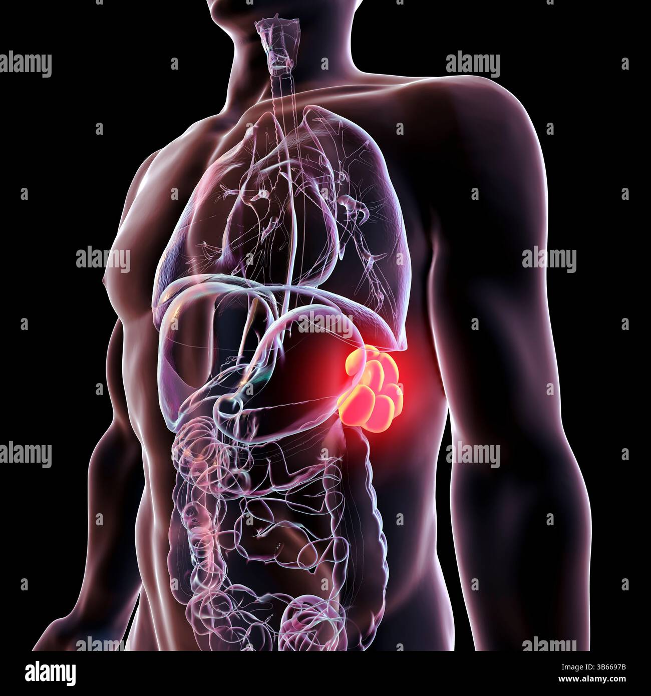 Illustration of polysplenia, a congenital condition characterised by the presence of multiple spleens instead of a single, normal-sized spleen. Stock Photo