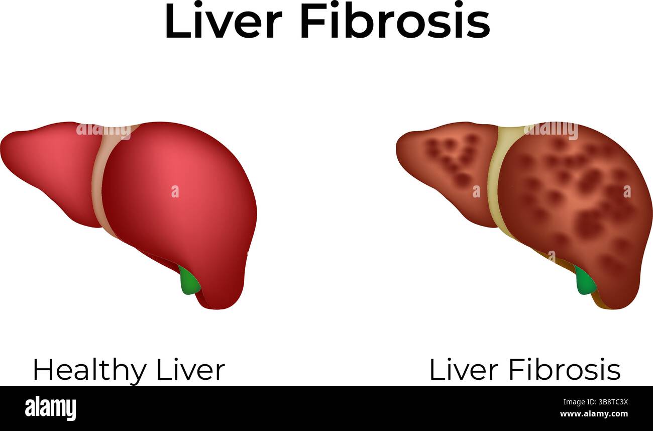 Healthy liver cirrhosis disease hi-res stock photography and images - Alamy